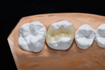 composite resin inlay onlay bridge crowns Invisalign clear aligners teeth reshaping gummy smile botox bonding teeth whitening miami best dentist straight teeth white teeth perfect teeth beautiful smile veneers smile design veneers