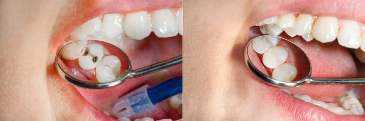 crowns Invisalign clear aligners teeth reshaping gummy smile botox bonding teeth whitening miami best dentist straight teeth white teeth perfect teeth beautiful smile veneers smile design veneers