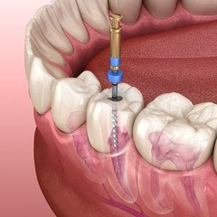 teeth reshaping gummy smile botox bonding teeth whitening miami best dentist straight teeth white teeth perfect teeth beautiful smile veneers smile design veneers