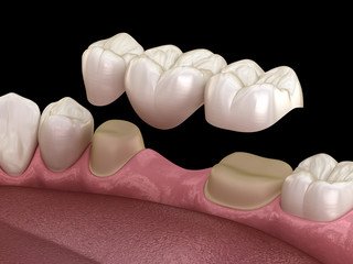 bridge crowns Invisalign clear aligners teeth reshaping gummy smile botox bonding teeth whitening miami best dentist straight teeth white teeth perfect teeth beautiful smile veneers smile design veneers