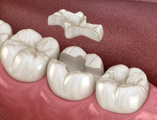 composite resin inlay onlay bridge crowns Invisalign clear aligners teeth reshaping gummy smile botox bonding teeth whitening miami best dentist straight teeth white teeth perfect teeth beautiful smile veneers smile design veneers