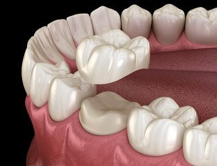 teeth reshaping gummy smile botox bonding teeth whitening miami best dentist straight teeth white teeth perfect teeth beautiful smile veneers smile design veneers