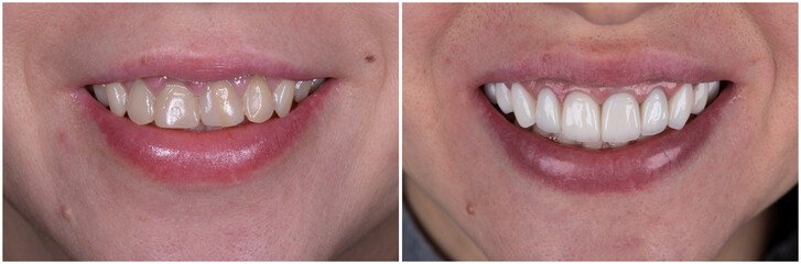 teeth reshaping gummy smile botox bonding teeth whitening miami best dentist straight teeth white teeth perfect teeth beautiful smile veneers smile design veneers