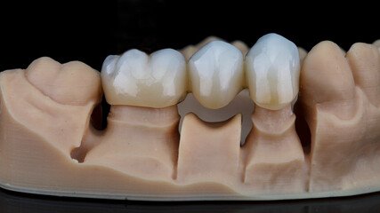 bridge crowns Invisalign clear aligners teeth reshaping gummy smile botox bonding teeth whitening miami best dentist straight teeth white teeth perfect teeth beautiful smile veneers smile design veneers