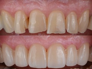 teeth reshaping gummy smile botox bonding teeth whitening miami best dentist straight teeth white teeth perfect teeth beautiful smile veneers smile design veneers