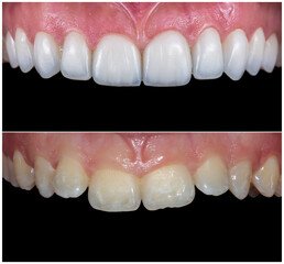 teeth reshaping gummy smile botox bonding teeth whitening miami best dentist straight teeth white teeth perfect teeth beautiful smile veneers smile design veneers