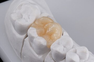 composite resin inlay onlay bridge crowns Invisalign clear aligners teeth reshaping gummy smile botox bonding teeth whitening miami best dentist straight teeth white teeth perfect teeth beautiful smile veneers smile design veneers