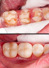 composite resin inlay onlay bridge crowns Invisalign clear aligners teeth reshaping gummy smile botox bonding teeth whitening miami best dentist straight teeth white teeth perfect teeth beautiful smile veneers smile design veneers