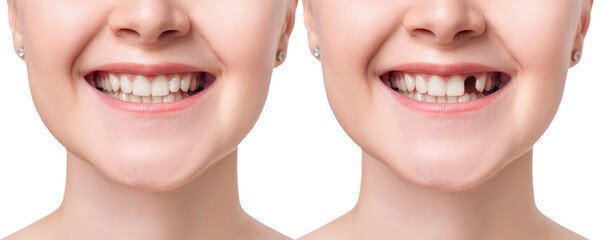 bridge crowns Invisalign clear aligners teeth reshaping gummy smile botox bonding teeth whitening miami best dentist straight teeth white teeth perfect teeth beautiful smile veneers smile design veneers