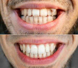 Invisalign clear aligners teeth reshaping gummy smile botox bonding teeth whitening miami best dentist straight teeth white teeth perfect teeth beautiful smile veneers smile design veneers