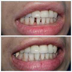 Invisalign clear aligners teeth reshaping gummy smile botox bonding teeth whitening miami best dentist straight teeth white teeth perfect teeth beautiful smile veneers smile design veneers