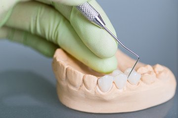crowns Invisalign clear aligners teeth reshaping gummy smile botox bonding teeth whitening miami best dentist straight teeth white teeth perfect teeth beautiful smile veneers smile design veneers