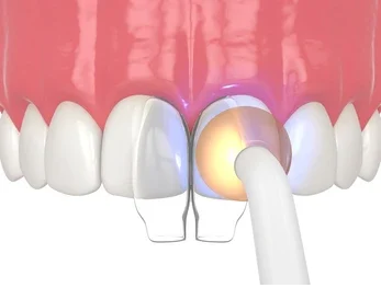 teeth reshaping gummy smile botox bonding teeth whitening miami best dentist straight teeth white teeth perfect teeth beautiful smile veneers smile design veneers