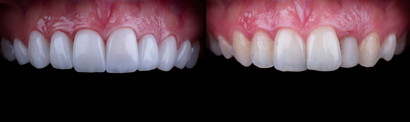 planning and making press ceramic veneers