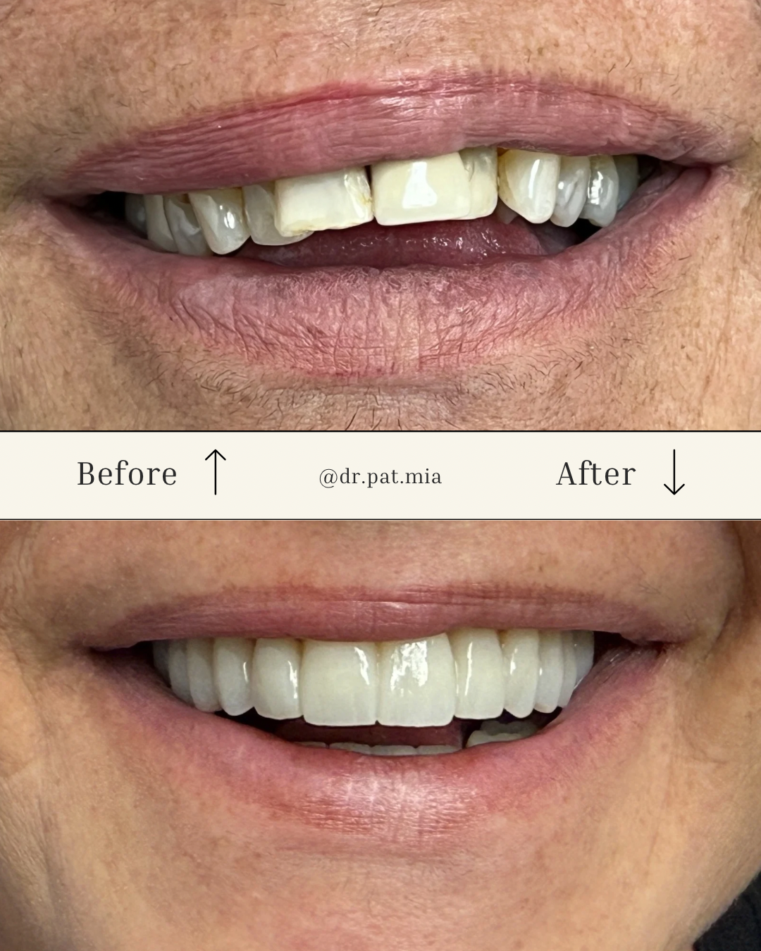  teeth whitening miami best dentist straight teeth white teeth perfect teeth beautiful smile veneers smile design veneers