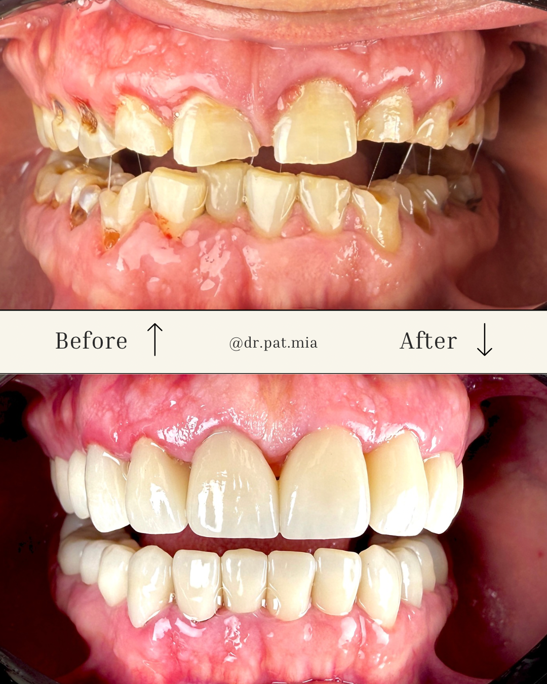  teeth whitening miami best dentist straight teeth white teeth perfect teeth beautiful smile veneers smile design veneers
