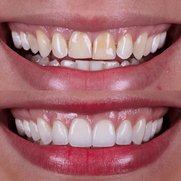 teeth reshaping gummy smile botox bonding teeth whitening miami best dentist straight teeth white teeth perfect teeth beautiful smile veneers smile design veneers