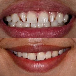 teeth reshaping gummy smile botox bonding teeth whitening miami best dentist straight teeth white teeth perfect teeth beautiful smile veneers smile design veneers