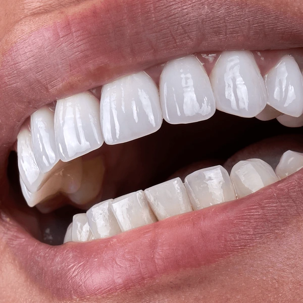 bonding teeth whitening miami best dentist straight teeth white teeth perfect teeth beautiful smile veneers smile design veneers