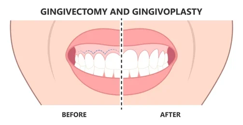 gummy smile botox bonding teeth whitening miami best dentist straight teeth white teeth perfect teeth beautiful smile veneers smile design veneers