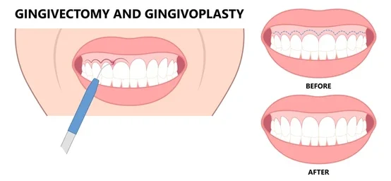 gummy smile botox bonding teeth whitening miami best dentist straight teeth white teeth perfect teeth beautiful smile veneers smile design veneers