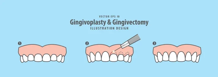 gummy smile botox bonding teeth whitening miami best dentist straight teeth white teeth perfect teeth beautiful smile veneers smile design veneers