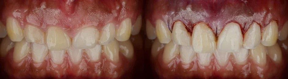 gummy smile botox bonding teeth whitening miami best dentist straight teeth white teeth perfect teeth beautiful smile veneers smile design veneers