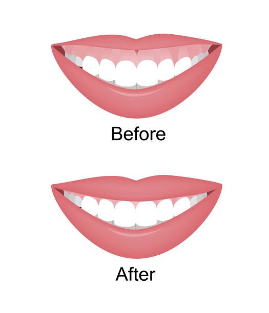 gummy smile botox bonding teeth whitening miami best dentist straight teeth white teeth perfect teeth beautiful smile veneers smile design veneers
