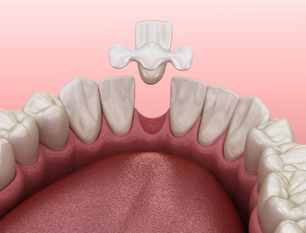 bonding teeth whitening miami best dentist straight teeth white teeth perfect teeth beautiful smile veneers smile design veneers