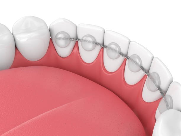 bonding teeth whitening miami best dentist straight teeth white teeth perfect teeth beautiful smile veneers smile design veneers