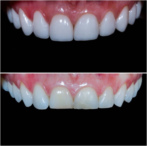 teeth reshaping gummy smile botox bonding teeth whitening miami best dentist straight teeth white teeth perfect teeth beautiful smile veneers smile design veneers