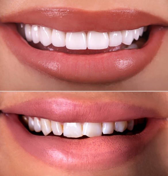 teeth reshaping gummy smile botox bonding teeth whitening miami best dentist straight teeth white teeth perfect teeth beautiful smile veneers smile design veneers