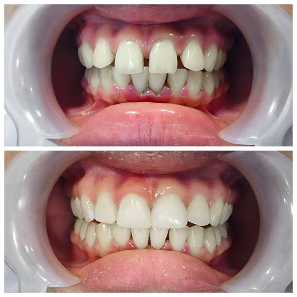 bonding teeth whitening miami best dentist straight teeth white teeth perfect teeth beautiful smile veneers smile design veneers