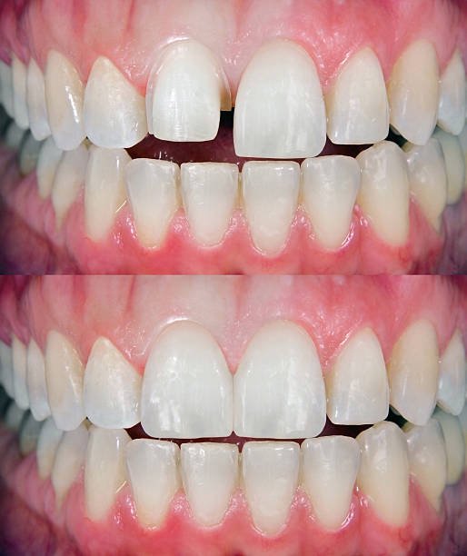 teeth reshaping gummy smile botox bonding teeth whitening miami best dentist straight teeth white teeth perfect teeth beautiful smile veneers smile design veneers