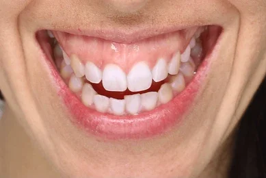 gummy smile botox bonding teeth whitening miami best dentist straight teeth white teeth perfect teeth beautiful smile veneers smile design veneers