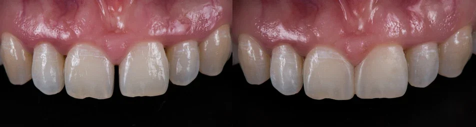 bonding teeth whitening miami best dentist straight teeth white teeth perfect teeth beautiful smile veneers smile design veneers