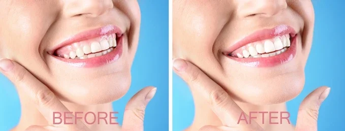 teeth reshaping gummy smile botox bonding teeth whitening miami best dentist straight teeth white teeth perfect teeth beautiful smile veneers smile design veneers