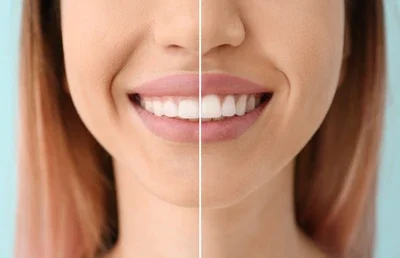 teeth reshaping gummy smile botox bonding teeth whitening miami best dentist straight teeth white teeth perfect teeth beautiful smile veneers smile design veneers