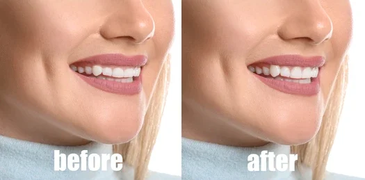 teeth reshaping gummy smile botox bonding teeth whitening miami best dentist straight teeth white teeth perfect teeth beautiful smile veneers smile design veneers