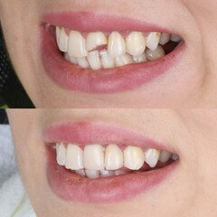 composite resin inlay onlay bridge crowns Invisalign clear aligners teeth reshaping gummy smile botox bonding teeth whitening miami best dentist straight teeth white teeth perfect teeth beautiful smile veneers smile design veneers
