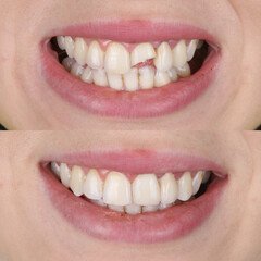 composite resin inlay onlay bridge crowns Invisalign clear aligners teeth reshaping gummy smile botox bonding teeth whitening miami best dentist straight teeth white teeth perfect teeth beautiful smile veneers smile design veneers