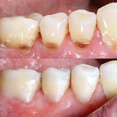 composite resin inlay onlay bridge crowns Invisalign clear aligners teeth reshaping gummy smile botox bonding teeth whitening miami best dentist straight teeth white teeth perfect teeth beautiful smile veneers smile design veneers