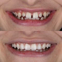composite resin inlay onlay bridge crowns Invisalign clear aligners teeth reshaping gummy smile botox bonding teeth whitening miami best dentist straight teeth white teeth perfect teeth beautiful smile veneers smile design veneers
