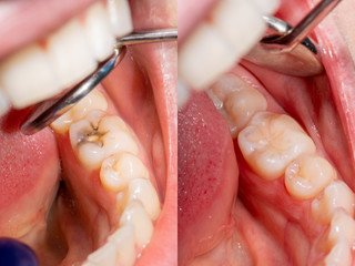 root canal dentures composite resin inlay onlay bridge crowns Invisalign clear aligners teeth reshaping gummy smile botox bonding teeth whitening miami best dentist straight teeth white teeth perfect teeth beautiful smile veneers smile design veneers