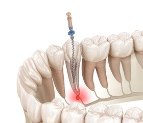 root canal dentures composite resin inlay onlay bridge crowns Invisalign clear aligners teeth reshaping gummy smile botox bonding teeth whitening miami best dentist straight teeth white teeth perfect teeth beautiful smile veneers smile design veneers