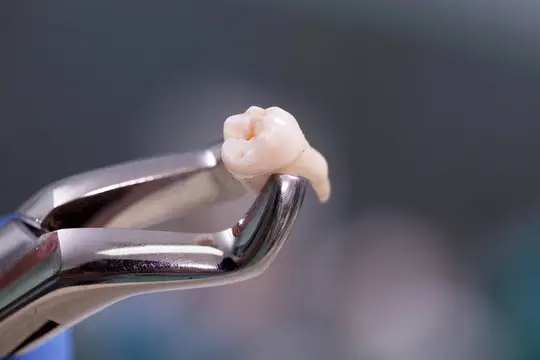 extraction tooth extract pulled out partial dentures removable root canal dentures composite resin inlay onlay bridge crowns Invisalign clear aligners teeth reshaping gummy smile botox bonding teeth whitening miami best dentist straight teeth white teeth perfect teeth beautiful smile veneers smile design veneers