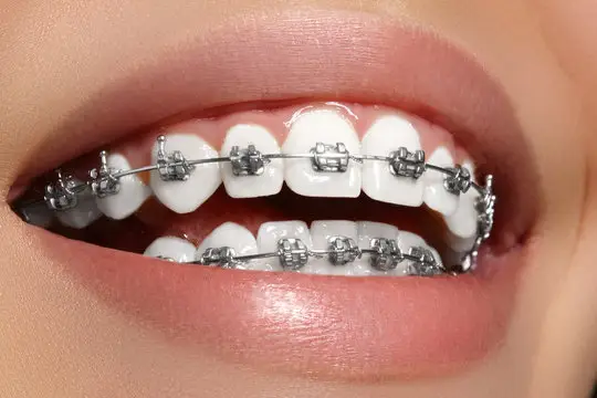 braces extraction tooth extract pulled out partial dentures removable root canal dentures composite resin inlay onlay bridge crowns Invisalign clear aligners teeth reshaping gummy smile botox bonding teeth whitening miami best dentist straight teeth white teeth perfect teeth beautiful smile veneers smile design veneers