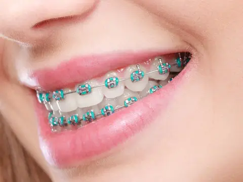 braces extraction tooth extract pulled out partial dentures removable root canal dentures composite resin inlay onlay bridge crowns Invisalign clear aligners teeth reshaping gummy smile botox bonding teeth whitening miami best dentist straight teeth white teeth perfect teeth beautiful smile veneers smile design veneers