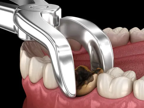 extraction tooth extract pulled out partial dentures removable root canal dentures composite resin inlay onlay bridge crowns Invisalign clear aligners teeth reshaping gummy smile botox bonding teeth whitening miami best dentist straight teeth white teeth perfect teeth beautiful smile veneers smile design veneers