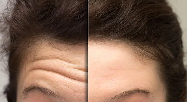 botox deep cleanning srp braces extraction tooth extract pulled out partial dentures removable root canal dentures composite resin inlay onlay bridge crowns Invisalign clear aligners teeth reshaping gummy smile botox bonding teeth whitening miami best dentist straight teeth white teeth perfect teeth beautiful smile veneers smile design veneers